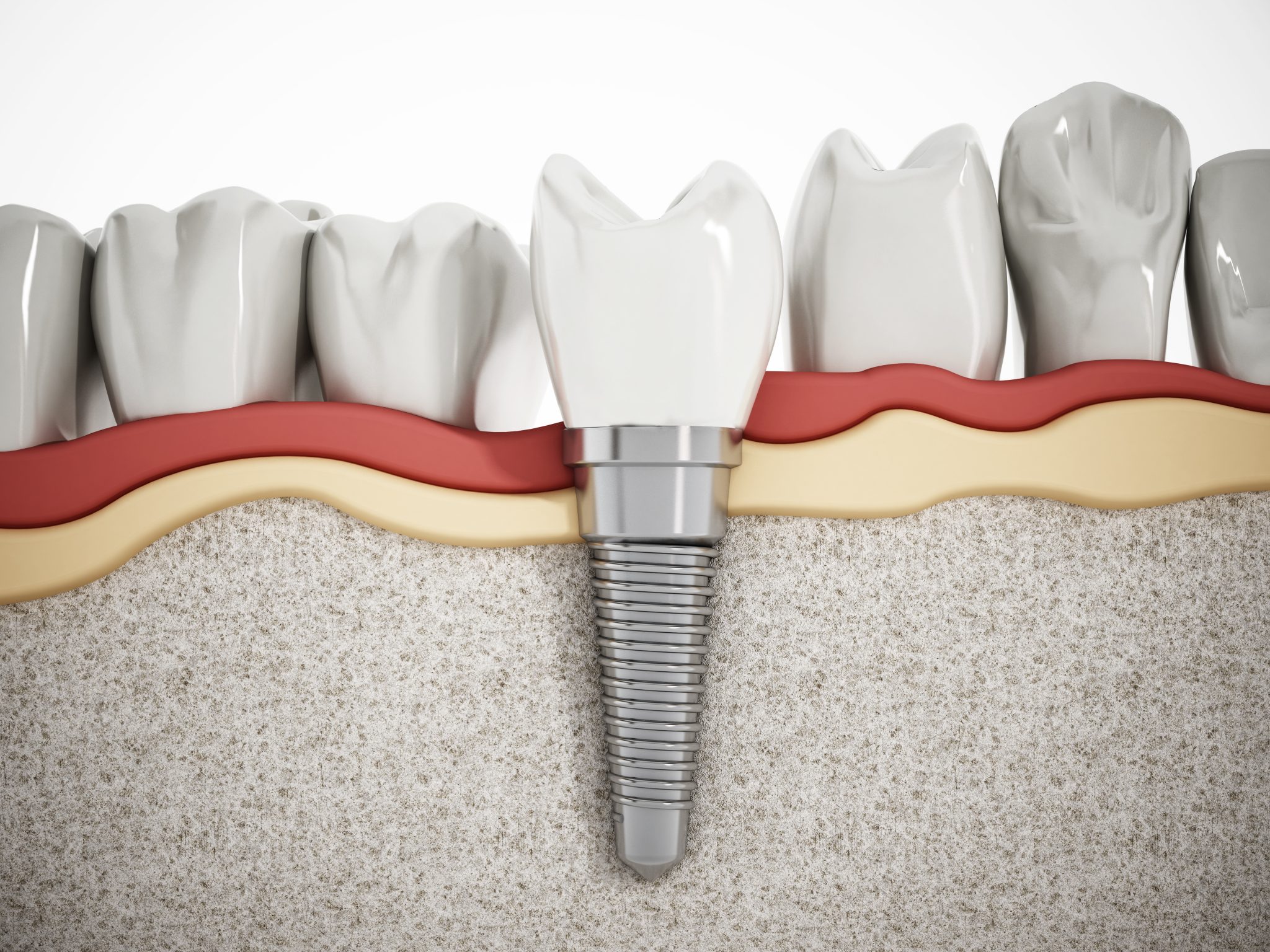 Dental implant detail